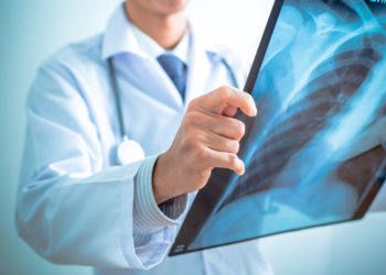 Wissenschaftlichen Untersuchungen zufolge könnte durch ein regelmäßiges Screening die Sterblichkeit bei Lungenkrebs deutlich gesenkt werden. (Bild: Nonwarit/fotolia.com)