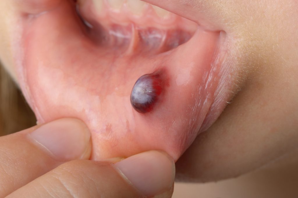 Bei Blutblasen im Mund sollte angesichts des Risikos einer Sekundärinfektion auf das Öffnen dringend verzichtet werden. (Bild fpic/fotolia.com)