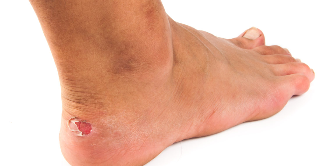 Blutblasen Ursachen, Therapie und Hausmittel Heilpraxis