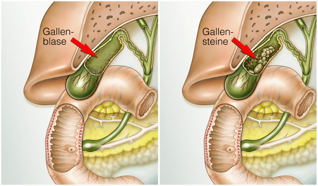 Gallensteine sind eine weitverbreitete Erkrankung. Viele Menschen wissen nicht einmal, dass sie Gallensteinen haben. Mediziner fanden heraus, dass Gallensteine das Risiko für eine Herzerkrankung erhöhen. (Bild: Henrie/fotolia.com)