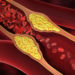 Gefäßverkalkungen lassen sich möglicherweise mit Hilfe von Omega-3-Fettsäuren therapieren. (Bild: psdesign1/fotolia.com)