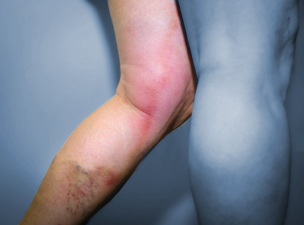 Blutplättchen Wie gefährliche Thrombosen entstehen Naturheilkunde