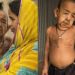 Der vierjährige Bayezid Hossain aus Bangladesch sieht aus wie ein 80-jähriger Greis. Mediziner rätseln, ob die seltene Erbkrankheit Progerie oder Inzucht für seinen Zustand verantwortlich ist. (Bild: Quelle: Youtube)