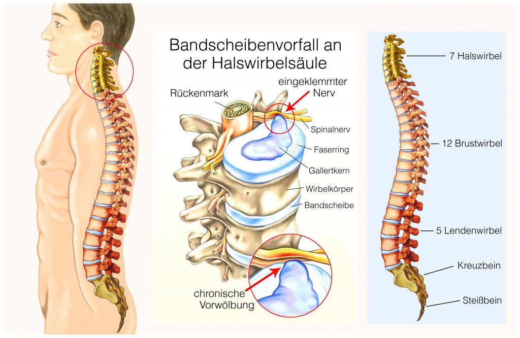 Bandenscheibenvorfall am Hals kann zu heftigen Schmerzen führen. Bild: © Henrie - fotolia