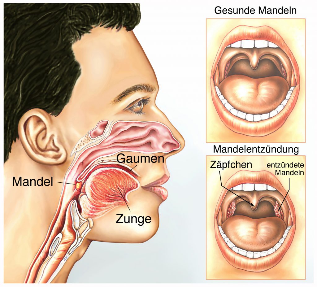 Mandelentzündung. Bild: Henrie - fotolia