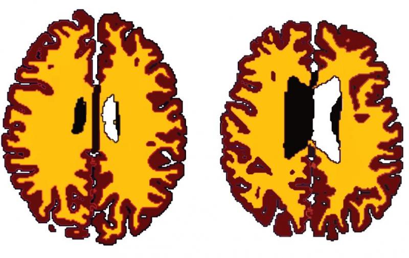 Vergleich der grauen Substanz (braun) und der weißen Substanz (gelb) bei einem 56 Jahre alten Normalgewichtigen (links) und einem 50 Jahre alten, adipösen Studienteilnehmer. (Bild: Dr. Lisa Ronan/University of Cambridge)