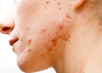 Sicherlich ist es keine Freude für Betroffene wenn diese unter Akne leiden. Forscher fanden heraus, dass Akne aber auch durchaus Vorteile haben könnte. Die Hauterkrankung kann eine langsamere Alterung der Haut bewirken. (Bild: Ocskay Bence/fotolia.com)