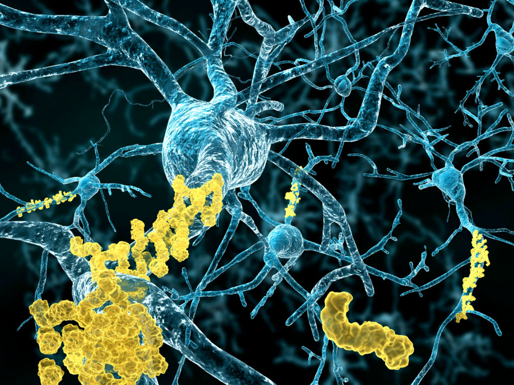 Die Bety-Amyloid-Plaques im Gehirn von Alzheimer-Patienten lassen sich durch einen speziellen Antikörper abbauen. (Bild: Juan Gärtner/fotolia.com)