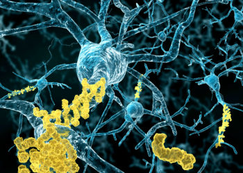 Die Bety-Amyloid-Plaques im Gehirn von Alzheimer-Patienten lassen sich durch einen speziellen Antikörper abbauen. (Bild: Juan Gärtner/fotolia.com)