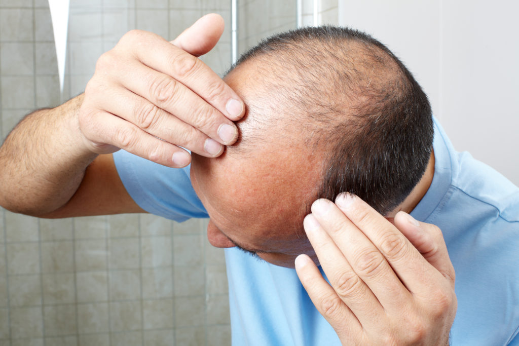 Wenn wir unter Haarverlust leiden, leidet auch oft unser Selbstbewusstsein. Forscher fanden jetzt heraus, dass ein Medikament bei vielen Menschen mit Alopecia areata zum Nachwachsen der Haare führt. (Bild: Kurhan/fotolia.com)