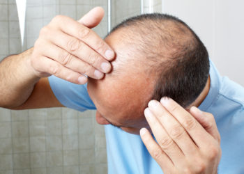 Wenn wir unter Haarverlust leiden, leidet auch oft unser Selbstbewusstsein. Forscher fanden jetzt heraus, dass ein Medikament bei vielen Menschen mit Alopecia areata zum Nachwachsen der Haare führt. (Bild: Kurhan/fotolia.com)