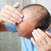 Wenn wir unter Haarverlust leiden, leidet auch oft unser Selbstbewusstsein. Forscher fanden jetzt heraus, dass ein Medikament bei vielen Menschen mit Alopecia areata zum Nachwachsen der Haare führt. (Bild: Kurhan/fotolia.com)