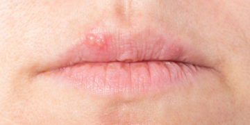 Gegen Lippenbläschen kann mit zahlreichen Hausmitteln vorgegangen werden, wobei sowohl eine innerliche als auch eine äußerliche Anwendung möglich ist. (Bild: bmf-foto.de/stock.adobe.com)