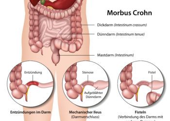 Chronische Darmerkrankungen können eine große Belastung für das Leben von Betroffenen sein. Morbus Crohn ist eine dieser Erkrankungen. Forscher fanden jetzt heraus, dass ein Pilz die Ursache für diese Probleme sein könnte. (Bild: bilderzwerg/fotolia.com)