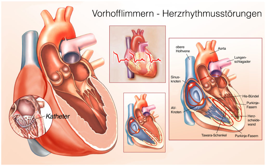 Menschen mit Vorhofflimmern haben ein erhöhtes Risiko für verschiedene Erkrankungen, so das Ergebnis einer neuen Studie. Betroffene versterben auch doppelt so häufig an den Auswirkungen von Herzerkrankungen. (Bild: Henrie/fotolia.com)