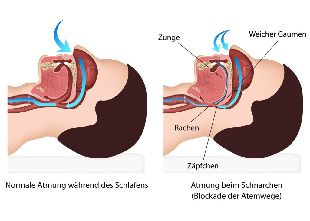 Neue Therapieansätze bei Schnarchen. Bild: bilderzwerg - fotolia