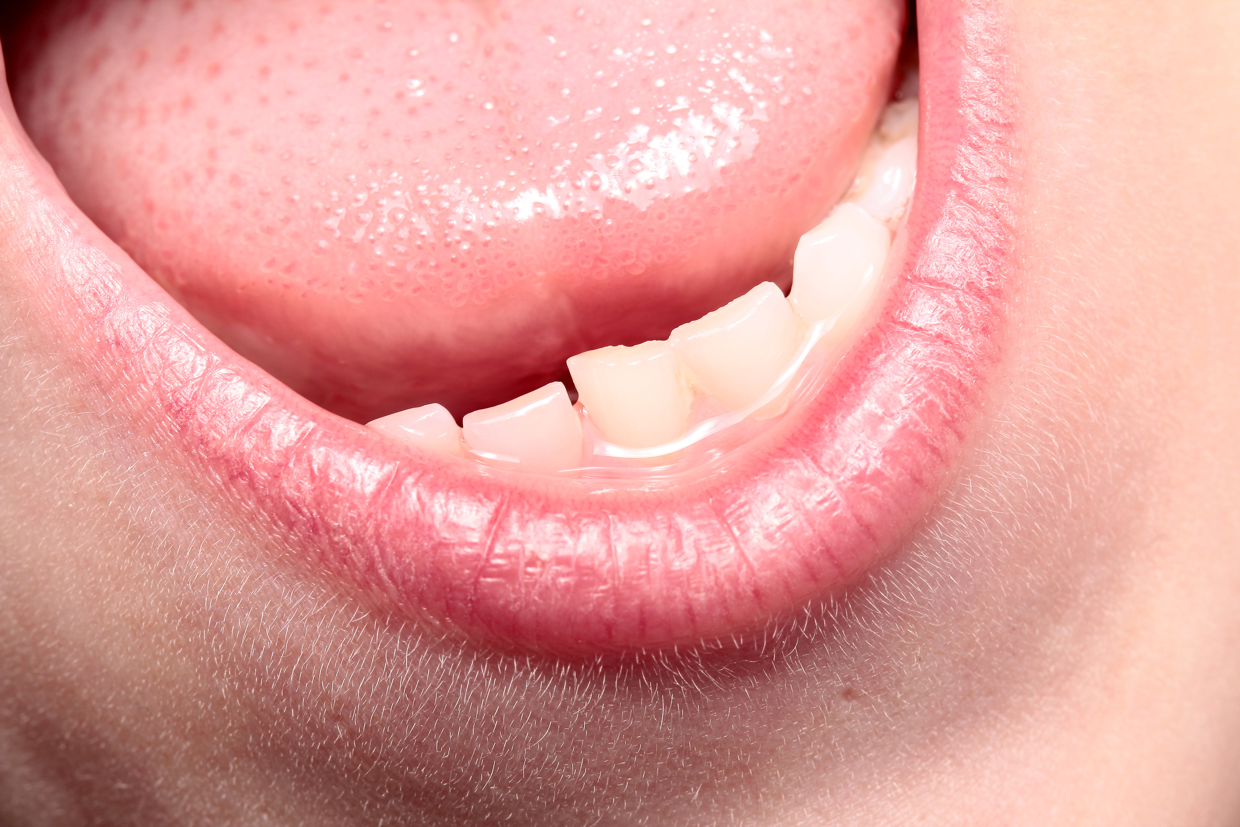 An zungenspitze pickel Zungenbrennen: Ursachen