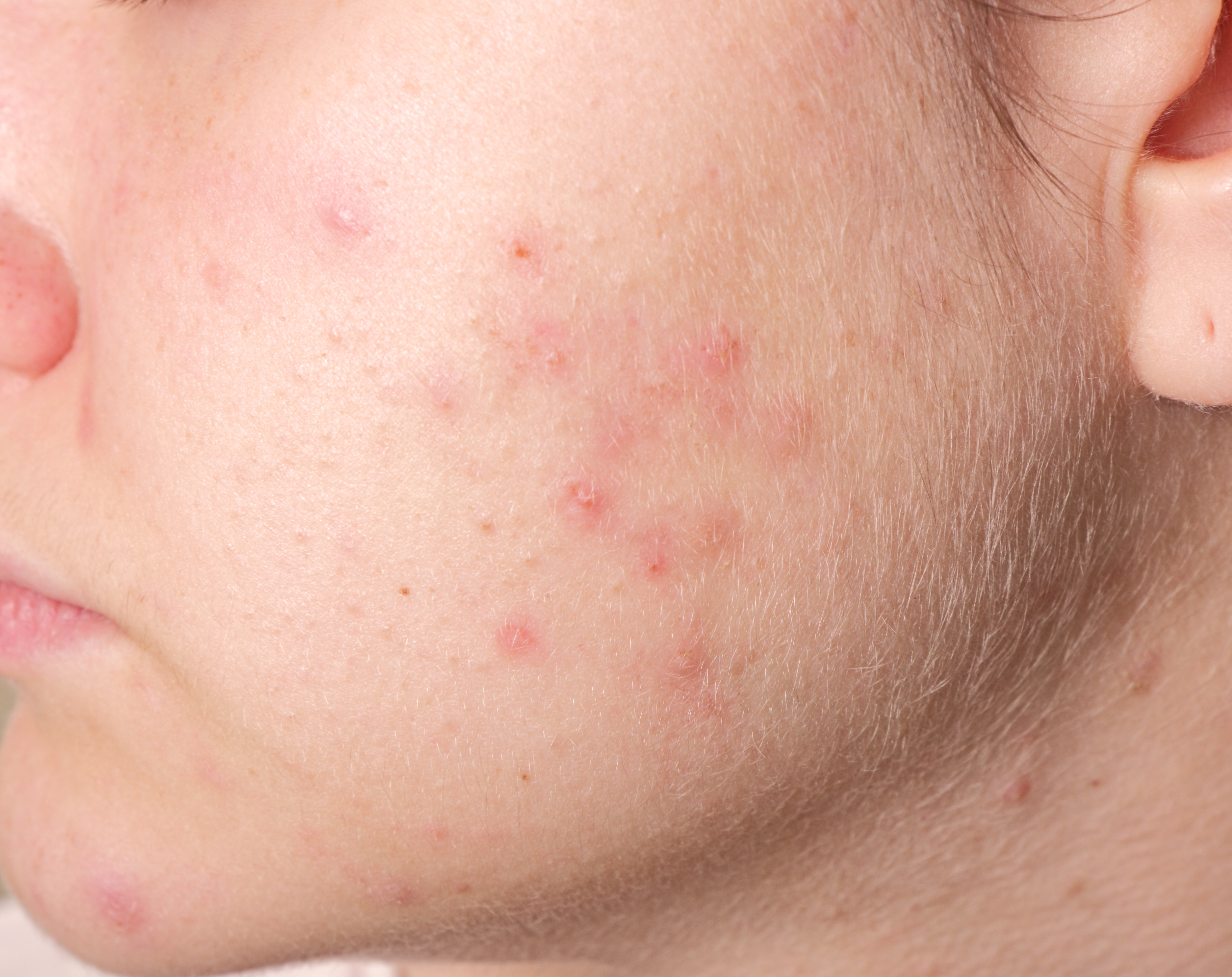 Verlängerte Telomere: Akne kann die Haut vor Alterung bewahren – Naturheilkunde ...