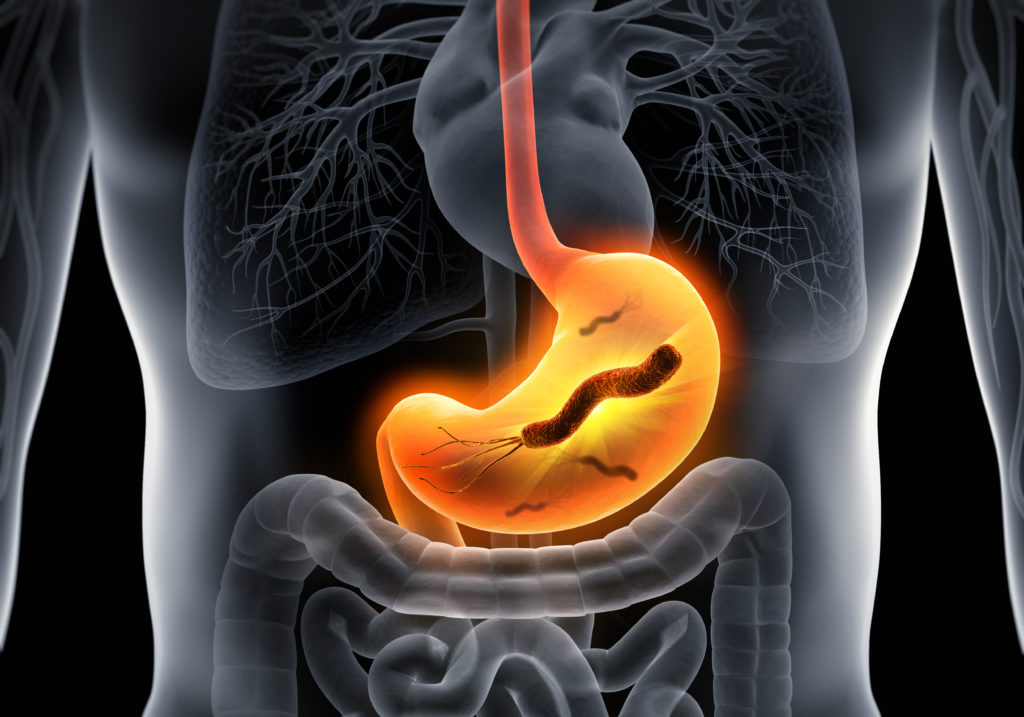 Infektionen mit Helicobacter pylori sind durchaus keine Seltenheit und ein beannter Risikofaktor für Magengeschwüre und Magenkrebs. (Bild: psdesign1/fotolia.com)