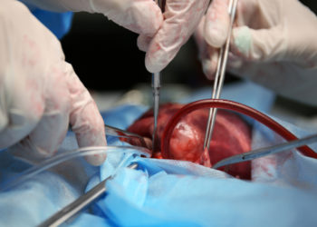Seit einiger Zeit gibt es immer mehr Infektionen bei offenen Herzoperationen. Mediziner fanden heraus, dass ein kontaminiertes Gerät an der Entstehung dieser Infektionen beteiligt sein könnte. (Bild: Africa Studio/fotolia.com)