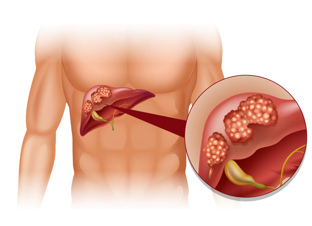 Übergewicht und Diabetes können andere Erkrankungen begünstigen. Eine solche Erkrankung ist Leberkrebs. Forscher stellten fest, dass Diabetes und ein zu hoher BMI das Risiko für Leberkrebs erheblich vergrößern. (Bild: blueringmedia/fotolia.com)