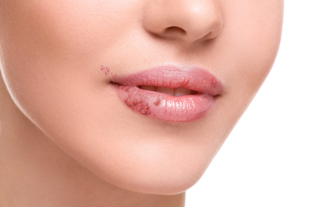 Eltern, die unter Lippenherpes leiden, sollten bei der Säuglingspflege stets einen Mundschutz tragen. Das Virus kann bei Neugeborenen lebensbedrohliche Situationen auslösen. (Bild: blackday/fotolia.com)