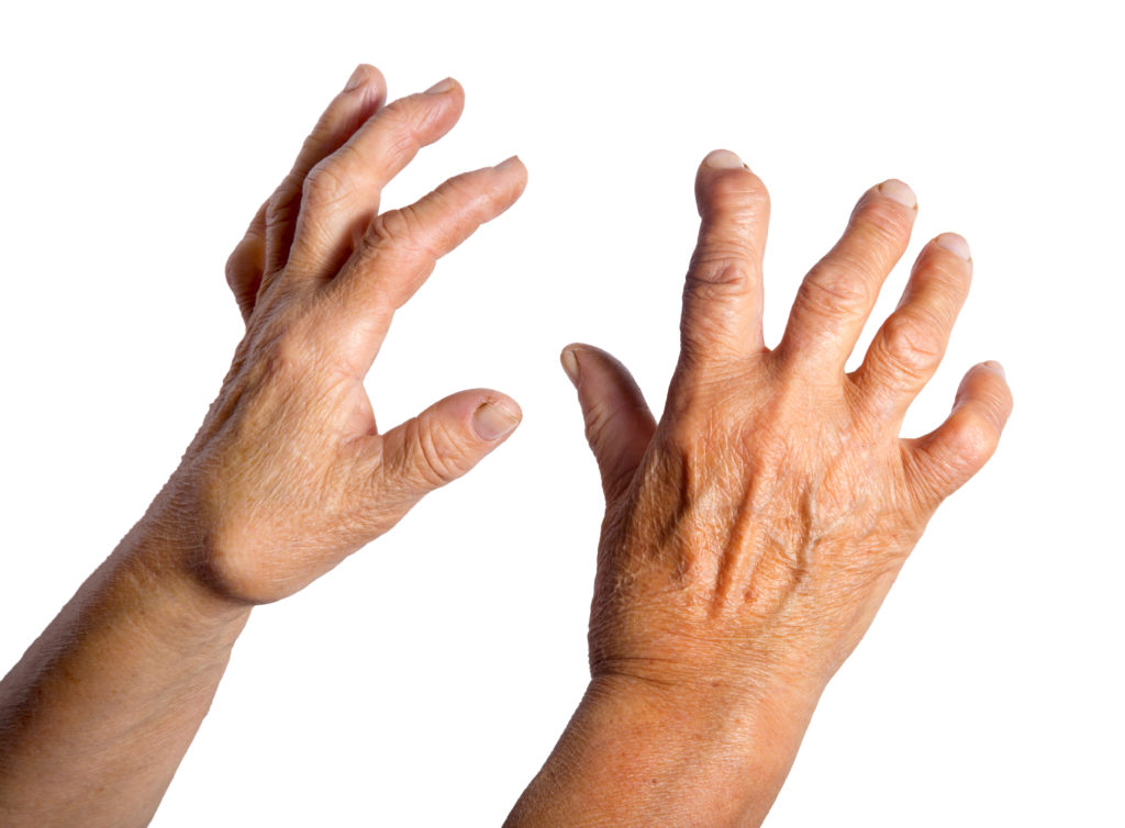 Bei der Rheumatoiden Arthritis werden die Gelenk zunehmend zerstört und in ihrer Funktion eingeschränkt. Training an der Spielkonsole kann helfen, die Beweglichkeit länger zu erhalten. (Bild hriana/fotolia.com) 