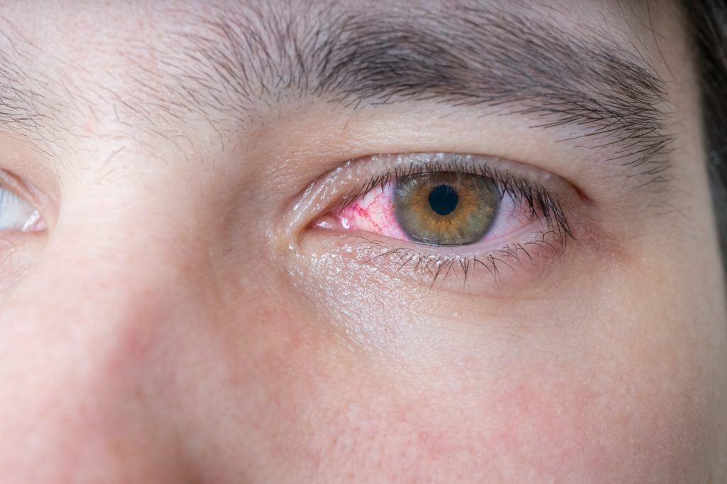 Blut im Auge kann verschiedene Ursachen haben. Manchmal steckt auch eine ernsthafte Erkrankung wie Diabetes dahinter. Bild: vchalup - fotolia