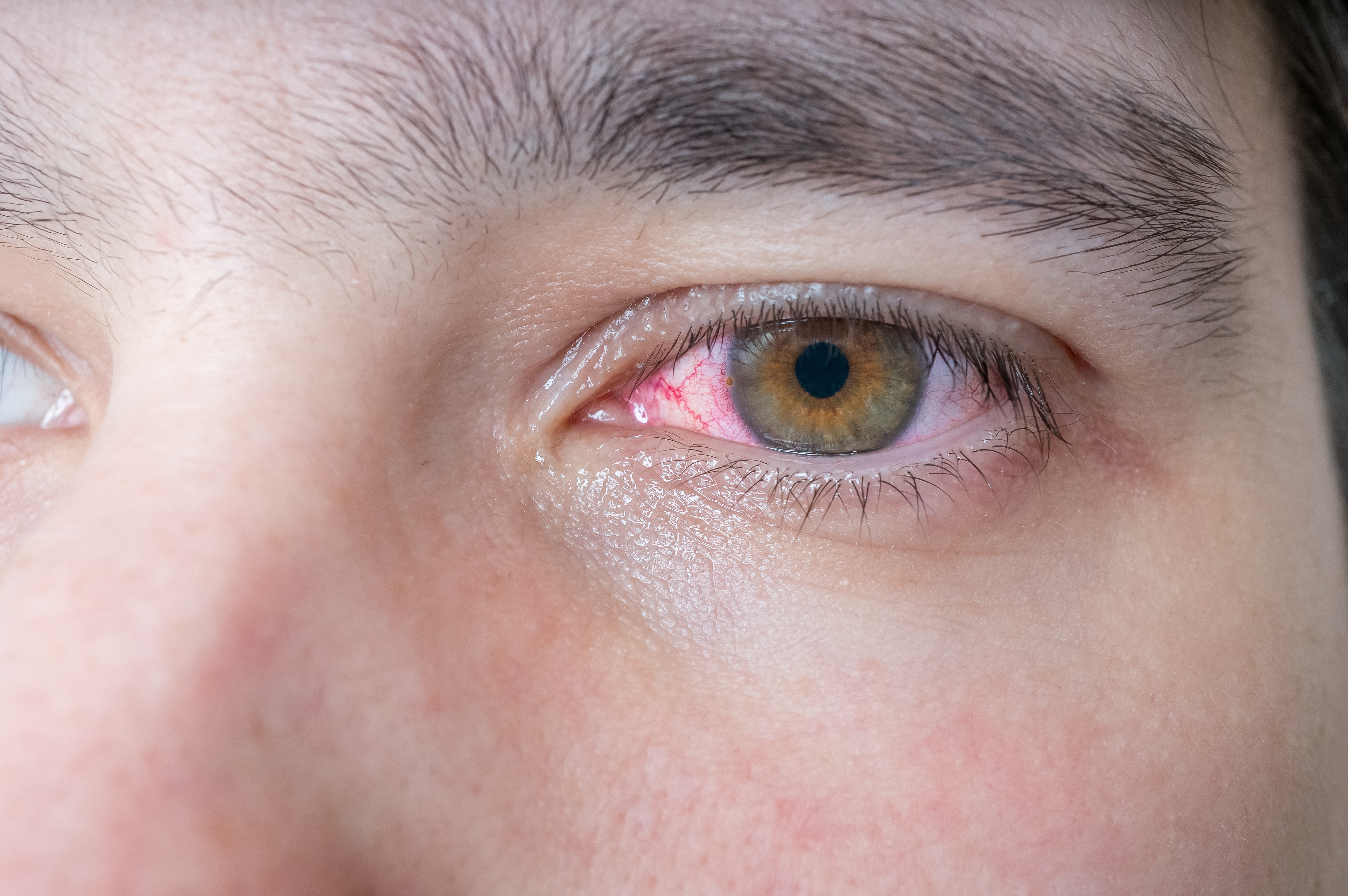 Blut im Auge - Ursachen, Symptome und Therapie.