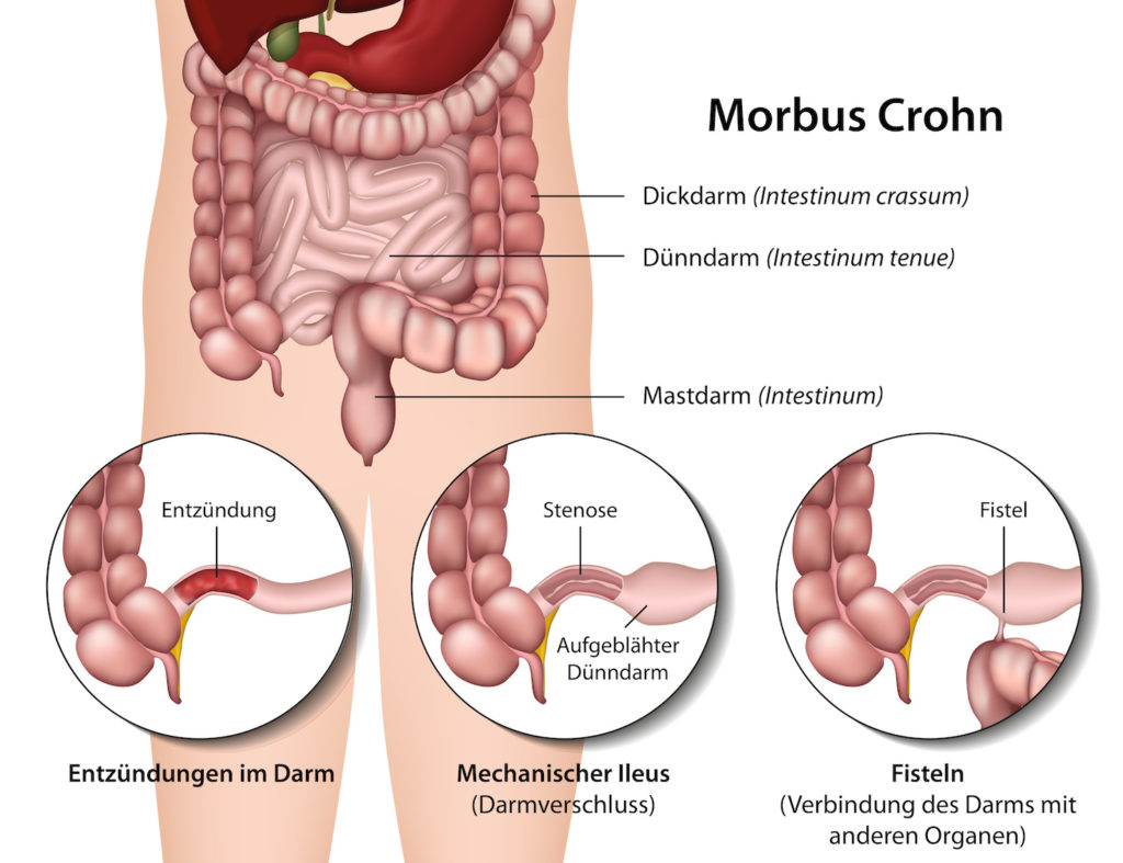 Eine schwere Darmerkrankung unterschiedlicher Ausprägung ist Morbus Chron. Bild: Bilderzwerg-fotolia