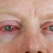 In den Herbstmonaten häufen sich die "Augengrippe"-Erkrankungen. Experten erklären, wie man sich vor einer Infektion schützen kann. (Bild: Birgit Reitz-Hofmann/fotolia.com)