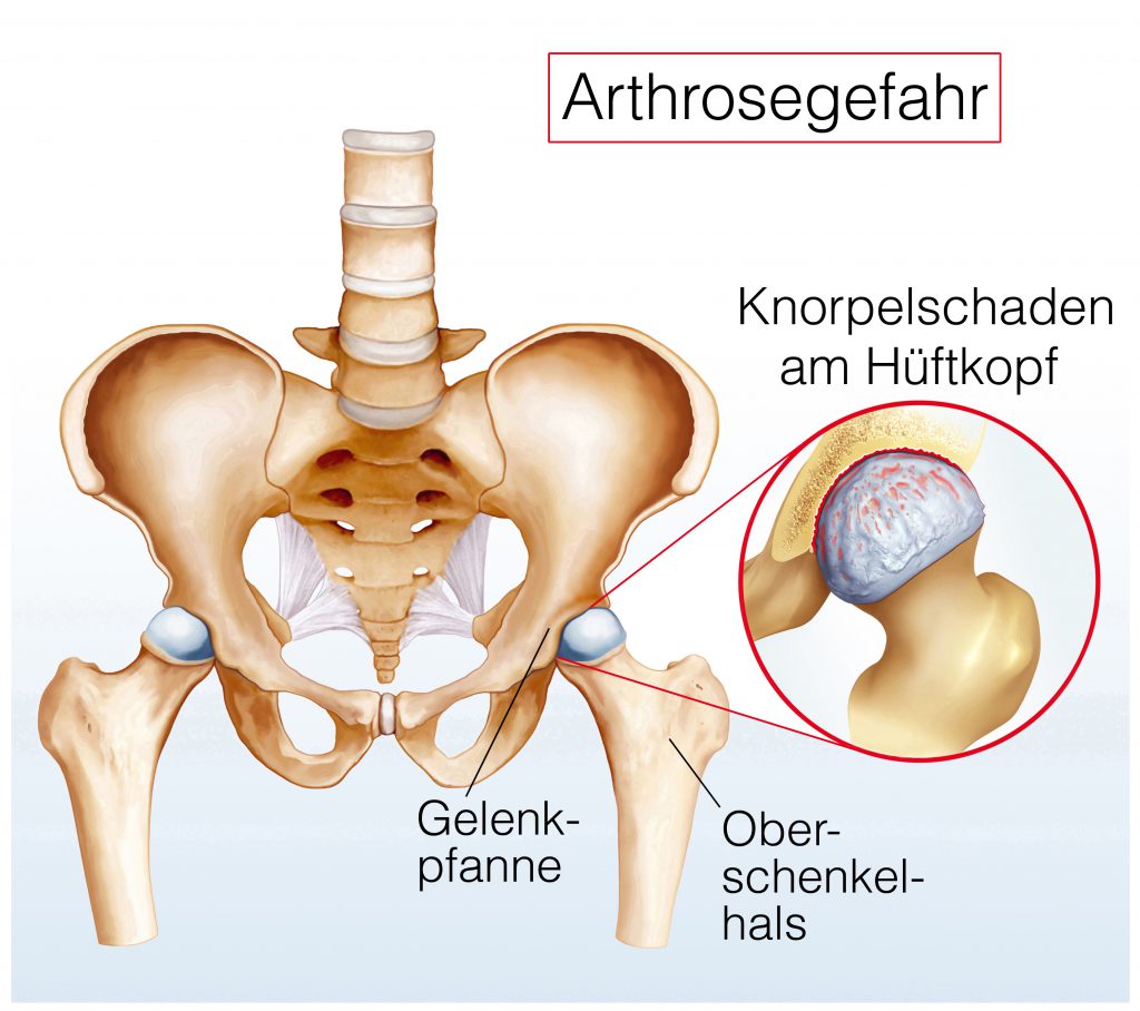 Oft sind Ermüdungsschmerzen erste Anzeichen bei einer Hüftarthrose. (Biild: Henrie/fotolia.com)