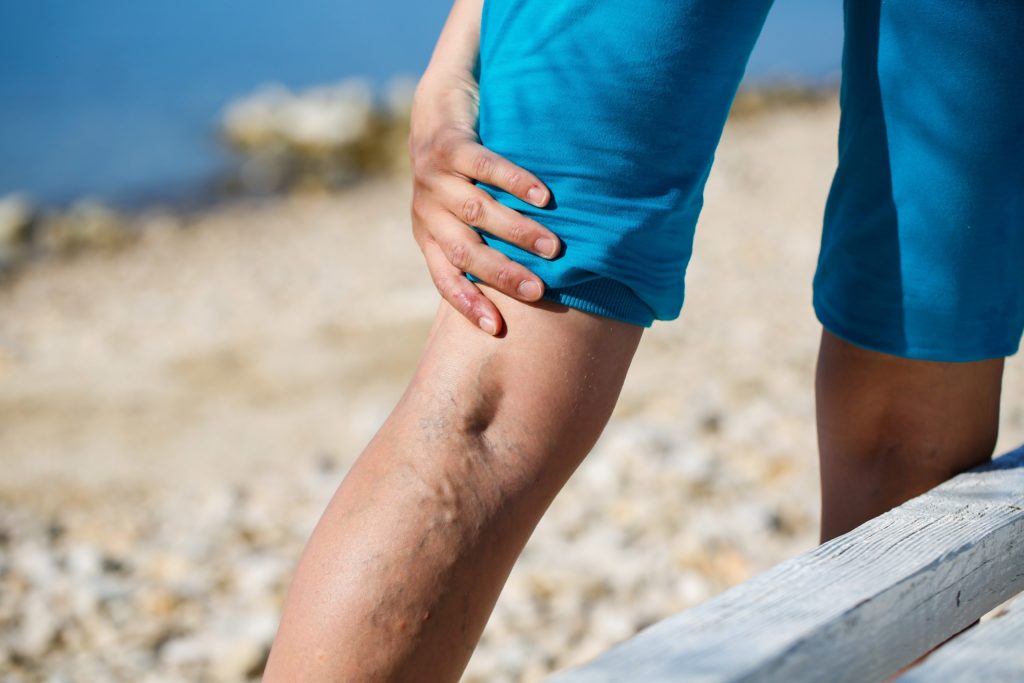 Manche Menschen haben familiär bedingt schon sehr früh unter Krampfadern zu leiden. Zur Behandlung des Venenleidens steht schon seit Jahren eine Radiowellentherapie zur Verfügung. (Bild: zlikovec/fotolia.com)