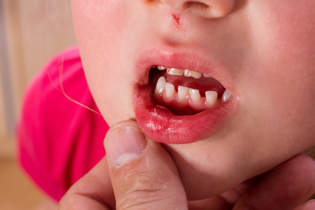 Geschwollene Lippen als Symptom. Bild: SENTELLO-fotolia