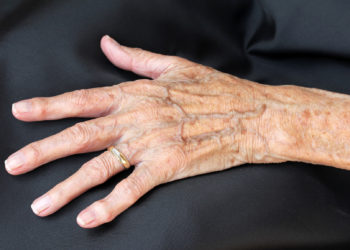 Hand mit dünner Haut