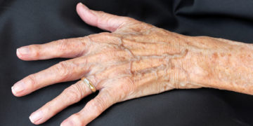 Hand mit dünner Haut