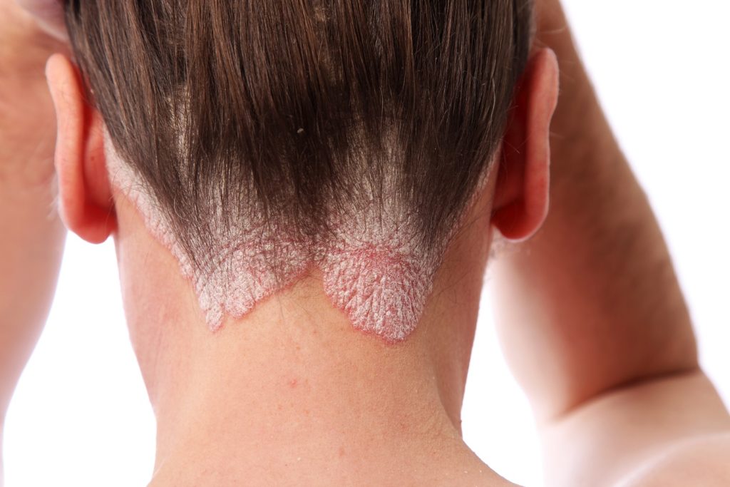 Etwa jeder fünfte Psoriatiker leidet unter der rheumatischen Form der Schuppenflechte. (Bild: Farina3000/fotolia.com) 