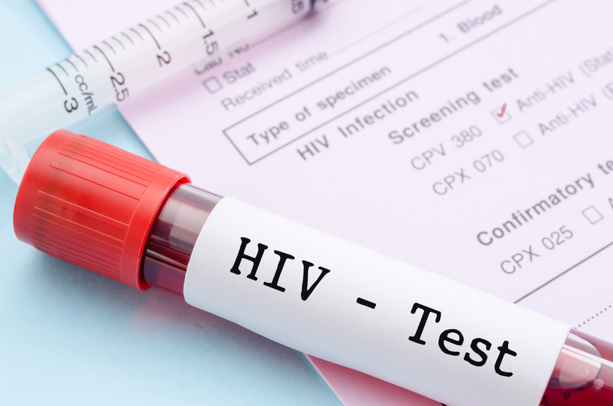 Viel zu wenig mutmaßlich Infizierte unterziehen sich einem HIV-Test (gamjai/fotolia.com)