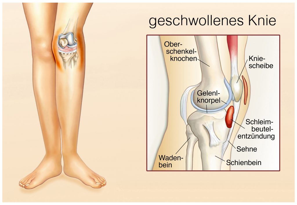 Ursache der Flüssigeitsansammlung sind oft Entzündungen und Verschleißerscheinungen, die die Strukturen im Knie schädigen. (Bild: Henrie/fotolia.com)