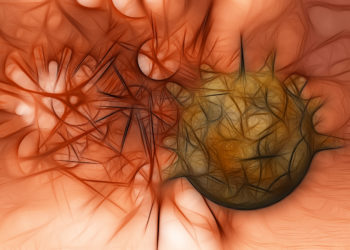 Krebs ist eine Erkrankung, welche nicht selten zum Tode des Betroffenen führt. Durch eine neue Behandlungsmethode mit sogenannten Nanodiscs könnten Tumore in Zukunft effektiver bekämpft werden. (Bild: vitanovski/fotolia.com)