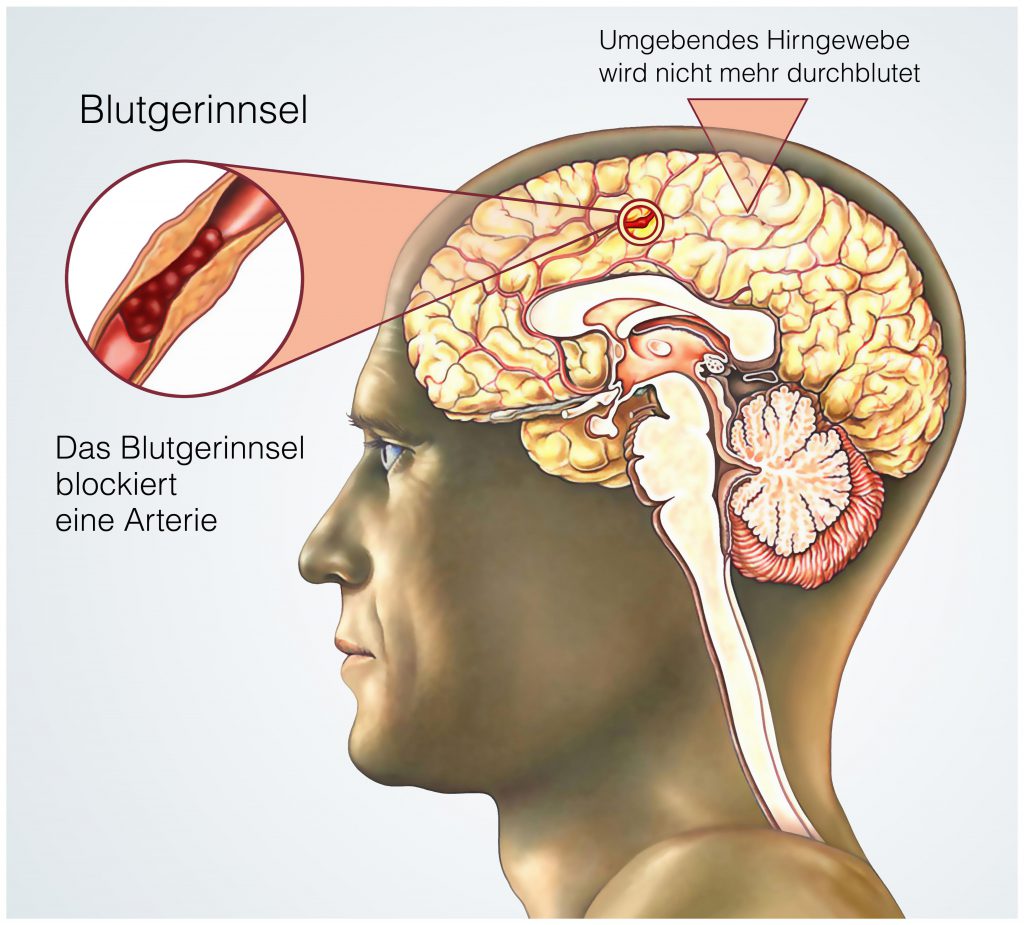 Zu den möglichen Auslösern der Bewusstlosigkeit zählt zum Beispiel ein Schlaganfall, der ein lebensbedrohliches Ereignis darstellt. (Bild: Henrie/fotolia.com)