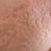 Aknenarben bringen für Betroffene oft eine Beeinträchtigung des Selbstwertgefühls mit sich, doch können die unschönen Narben in der Regel erfolgreich beseitigt werden. (Bild: Budimir Jevtic/fotolia.com)