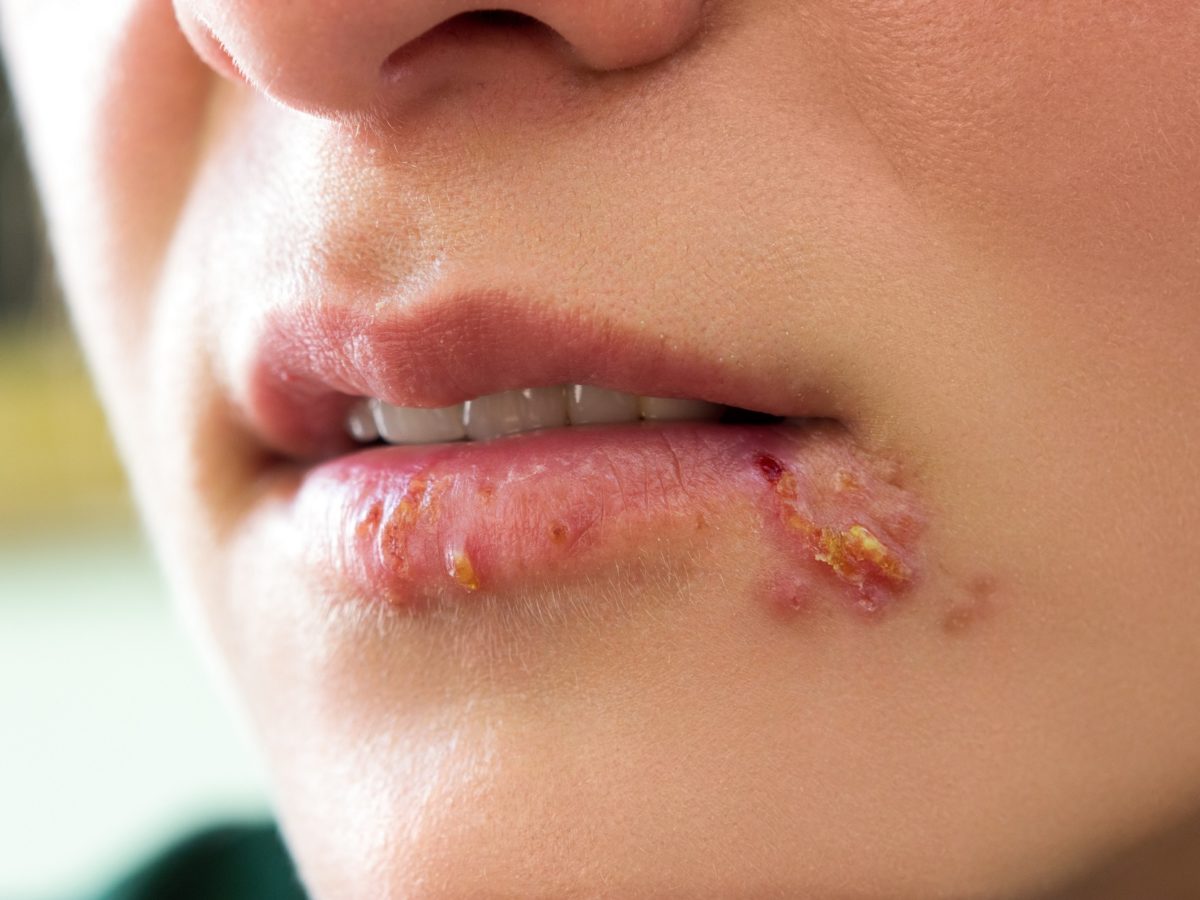 Wie bekommt man herpes weg