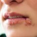 Bei akutem Herpes sollte aufs Küssen besser verzichtet werden. (Bild: Cherries/fotolia.com)