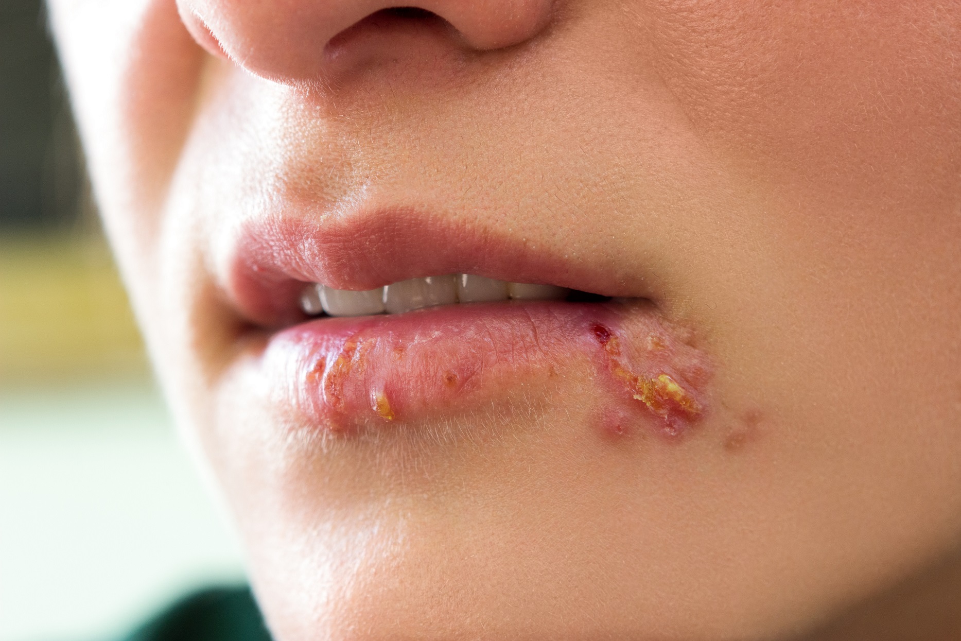 Herpes bleibt wie lange Lippenherpes: Dauer,