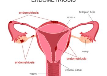 Bei einer Endometriose sind oftmals starke Regelschmerzen festzustellen. (Bild: fancytapis/fotolia.com)