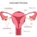 Bei einer Endometriose sind oftmals starke Regelschmerzen festzustellen. (Bild: fancytapis/fotolia.com)