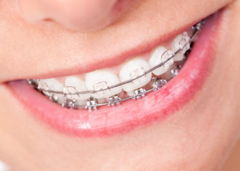 Was tun bei schiefen Zähnen? Bild: unpict - fotolia