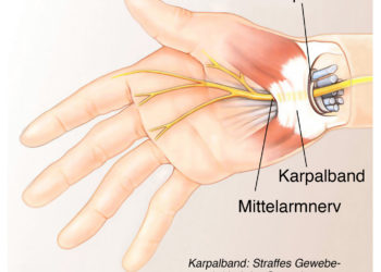 Bei einem Karpaltunnel-Syndrom sind ebenfalls taube Finger eine typische Folge. (Bild: Henrie/fotolia.com)