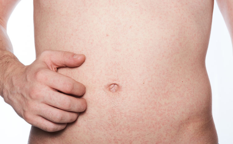 Ausschlag am Bauch – Heilpraxis